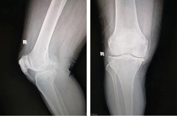 膝关节增生软骨磨损