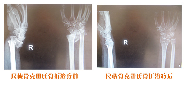 尺桡骨骨折治疗前后