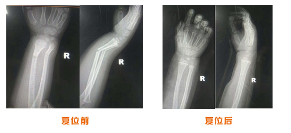 骨折和骨裂的区别